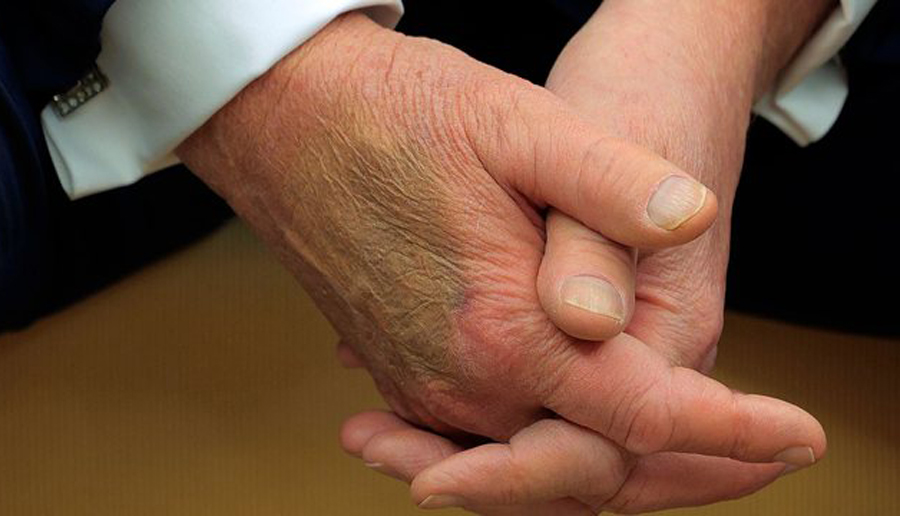Помодрените раце на Трамп покренуваат прашања за неговото здравје